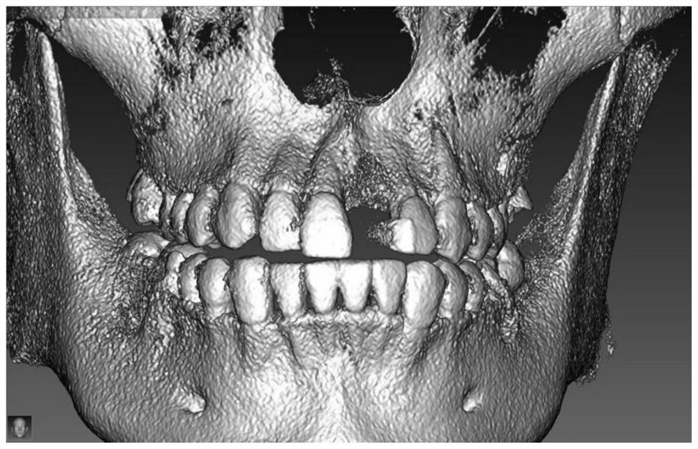 Individualized abutment-crown integration provisional prosthesis and preparation method and application thereof