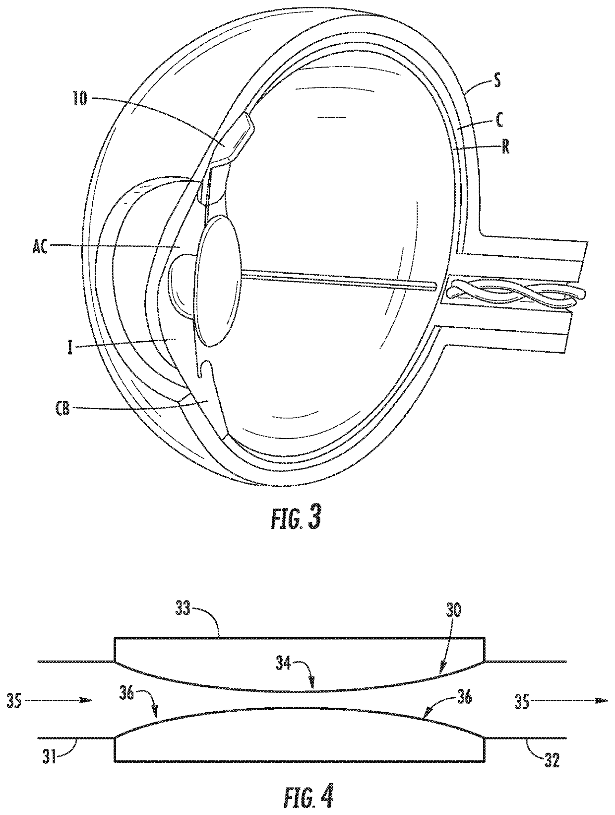 Apparatus for treating excess intraocular fluid