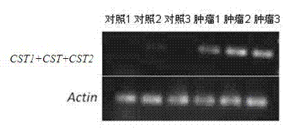 Tumor markers associated with pancreatic cancer and application thereof