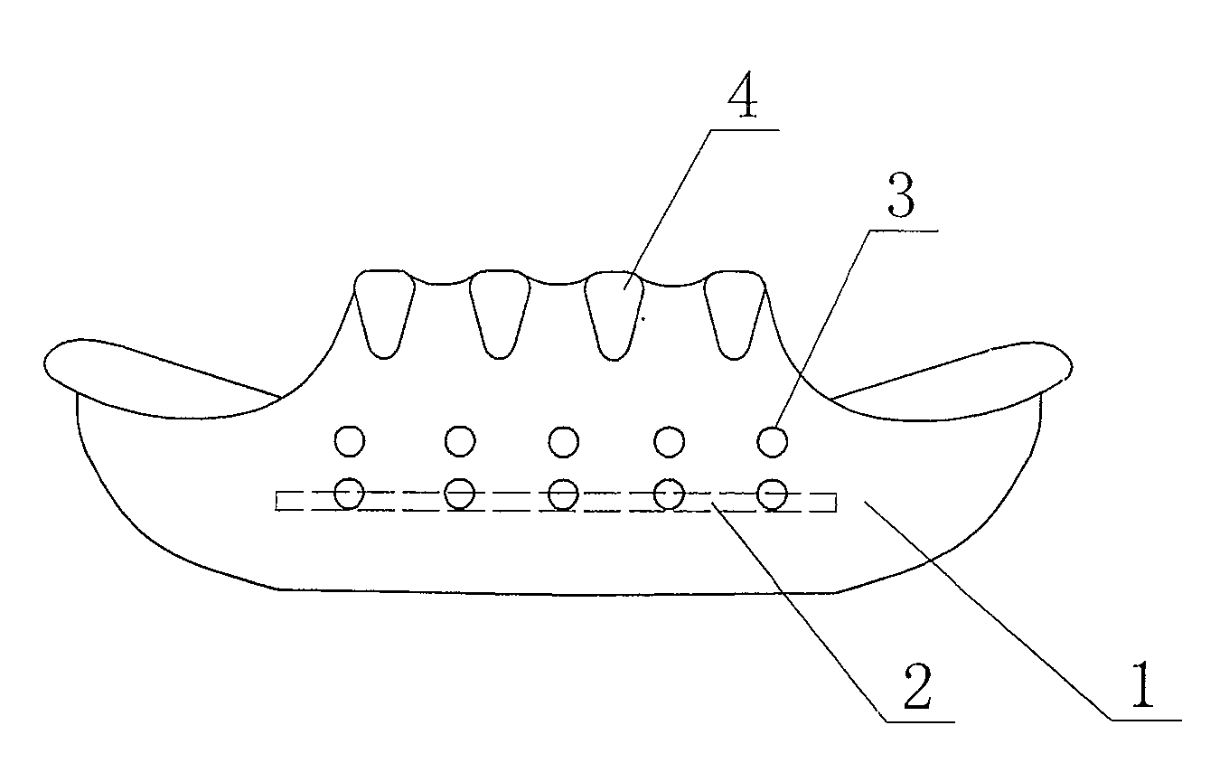 Anterior teeth cross-bite appliance