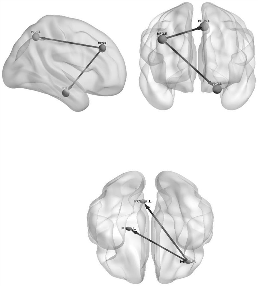 Effective connection method for coupling relationship of different brain regions of teenager patient with myoclonus epilepsy