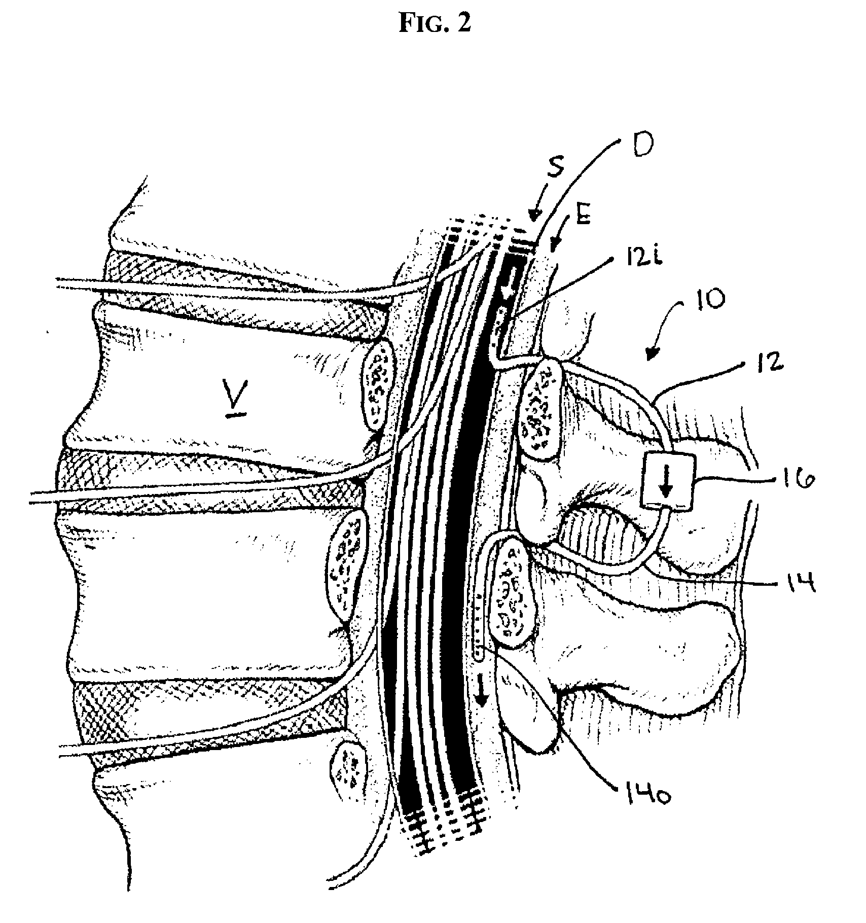 Subarachnoid epidural shunt