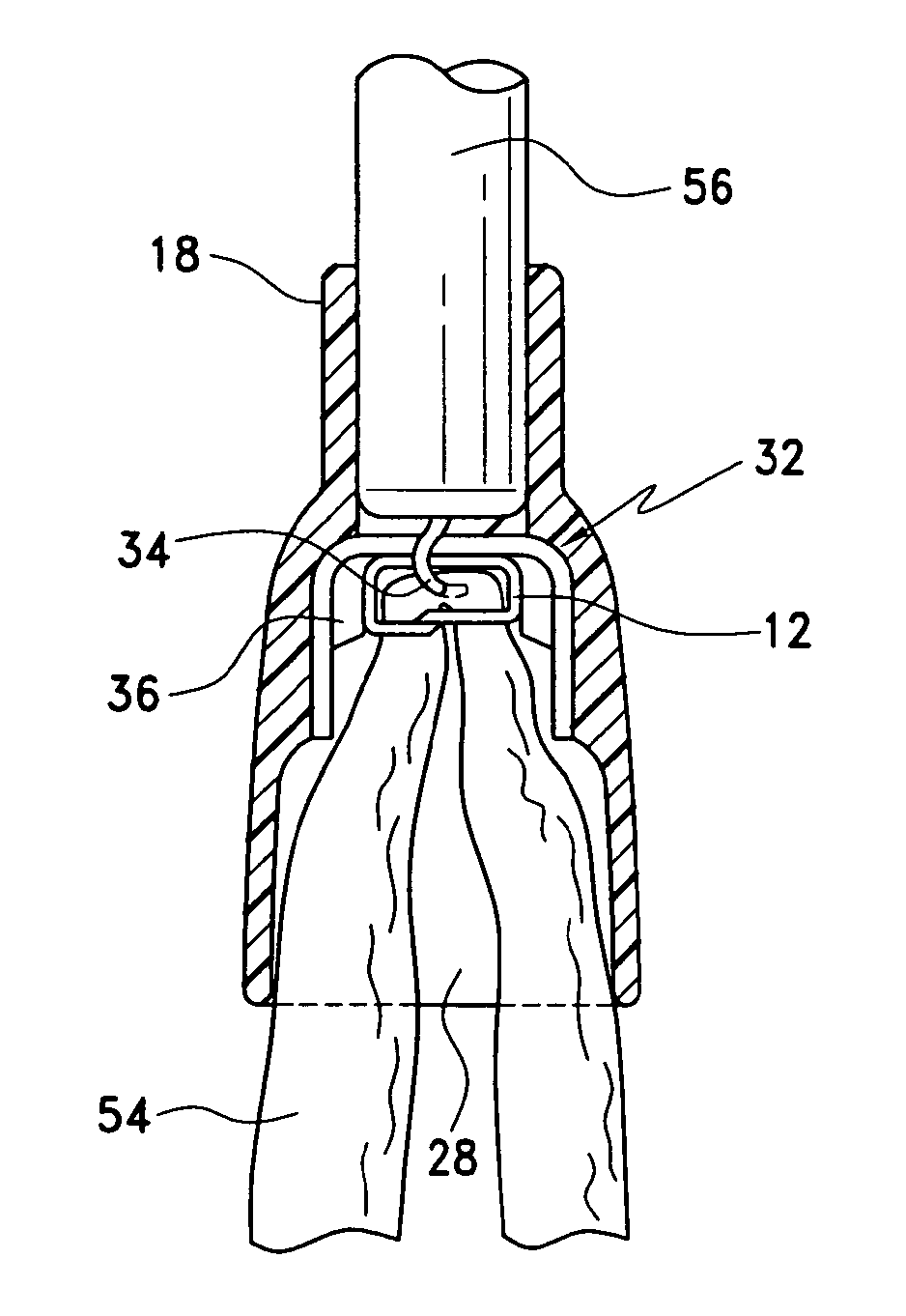 Method And Apparatus For Endoscopically Performing Gastric Reduction Surgery In A Single Pass