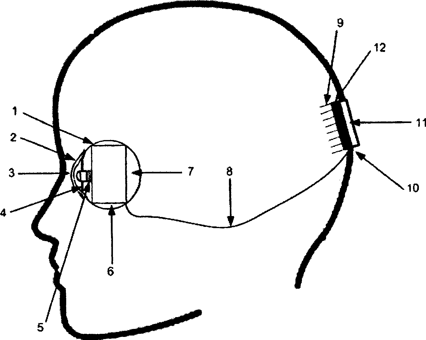 Implantable vision prosthesis