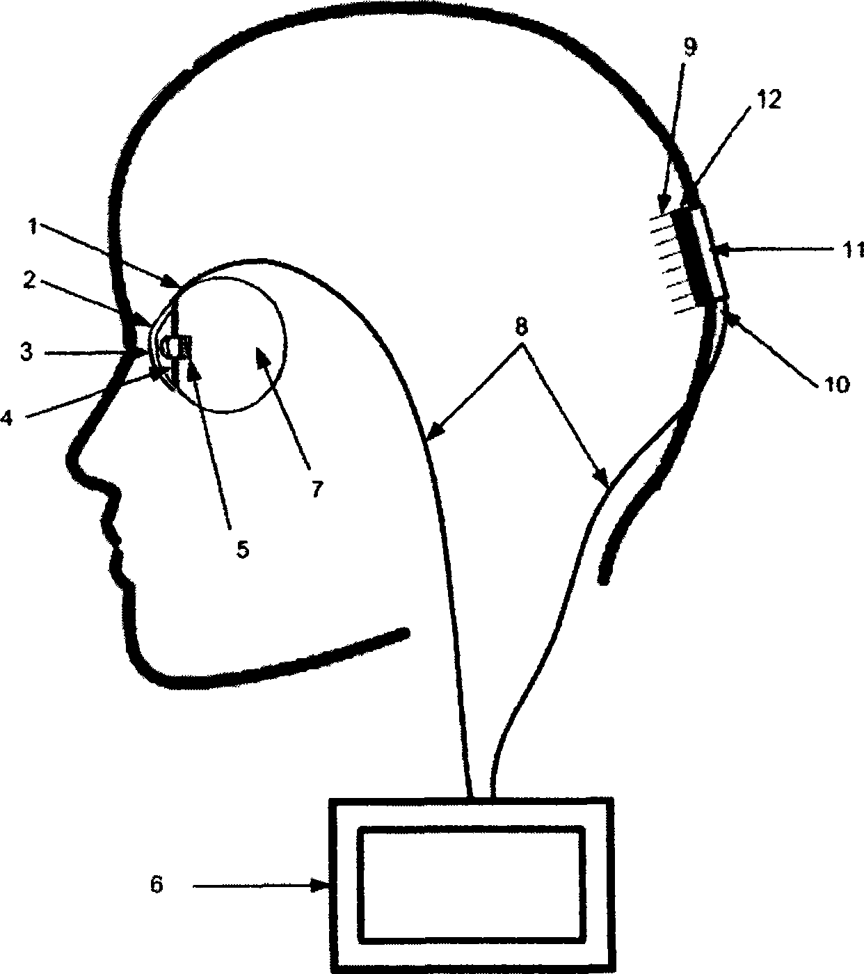 Implantable vision prosthesis