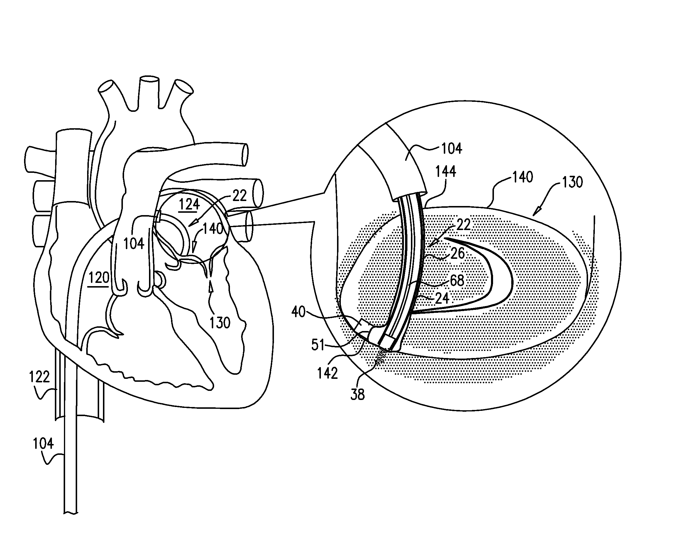 Annuloplasty ring with intra-ring anchoring