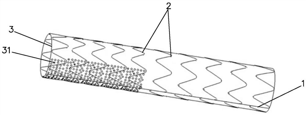 Novel covered intravascular stent used for aortic arch