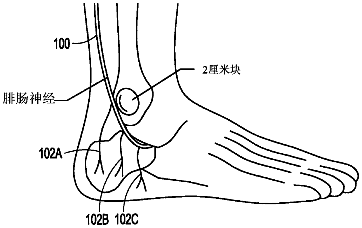 Restless leg syndrome or overactive nerve treatment