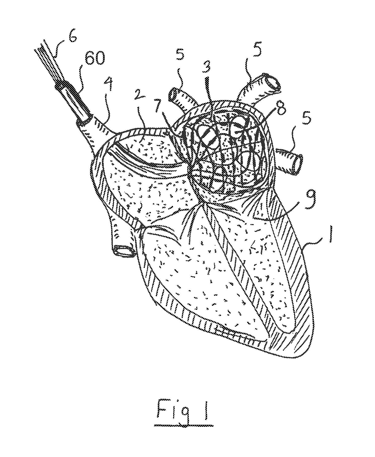 Apparatus and method for intra-cardiac mapping and ablation