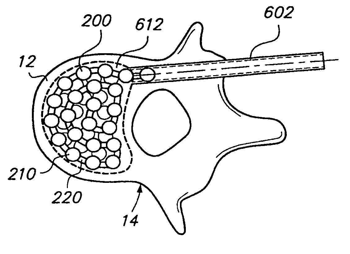 Flexible elongated chain implant and method of supporting body tissue with same