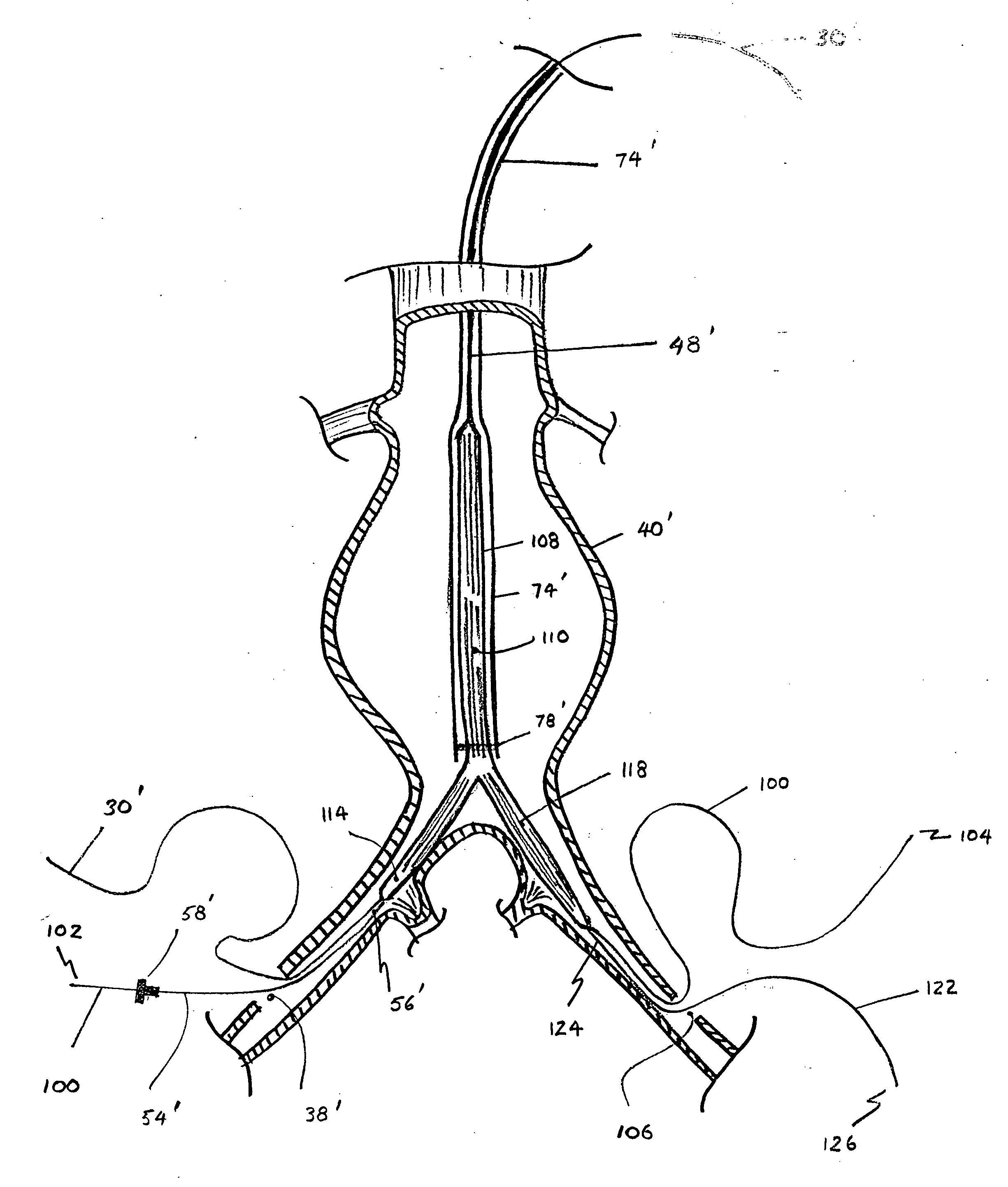 Device and method for staged implantation of a graft for vascular repair