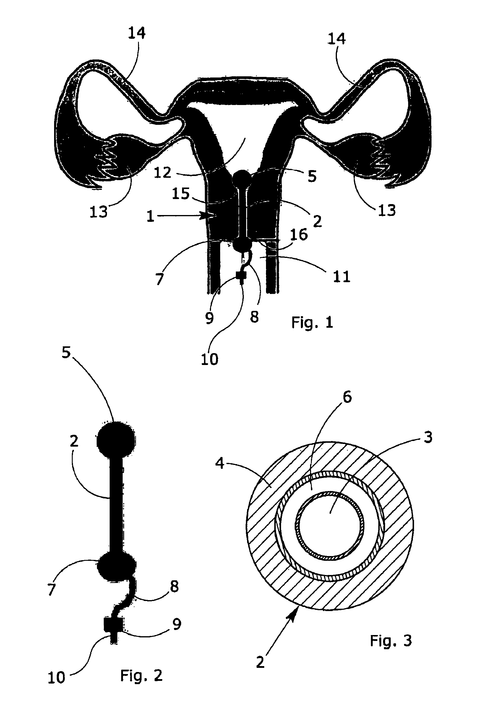 Process and intra-cervical device for the local release of drugs in the local-regional treatment of cervical cancer