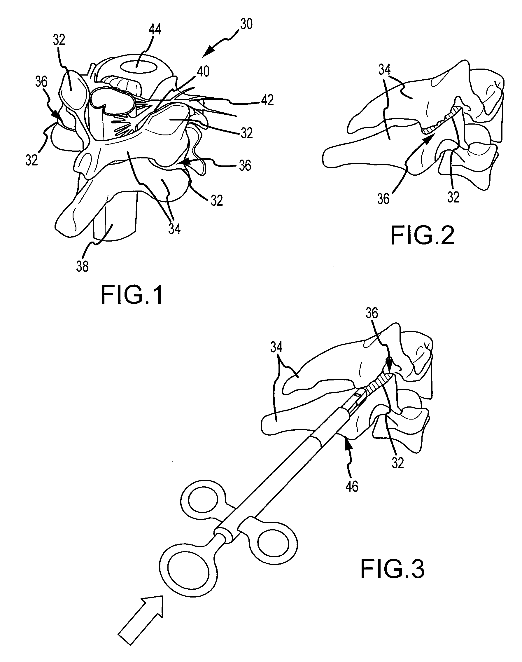 Cervical distraction/implant delivery device