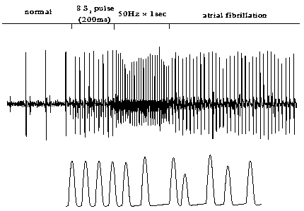 Application of Vanoxerine in medicine for persistent atrial fibrillation