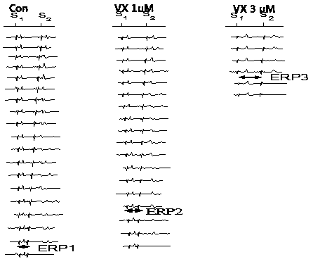 Application of Vanoxerine in medicine for persistent atrial fibrillation