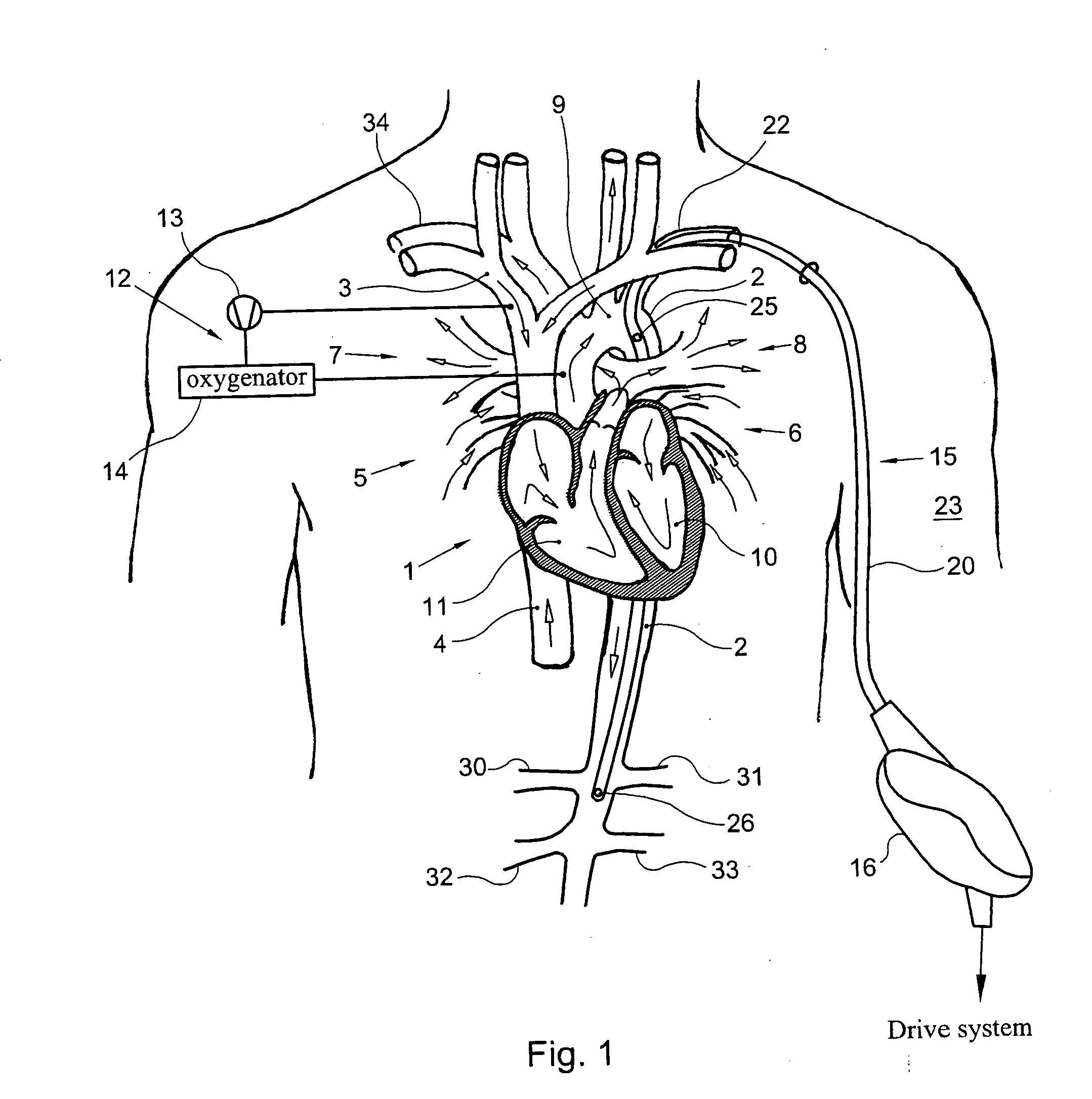 Catheter pump, catheter and fittings therefore and methods of using a catheter pump