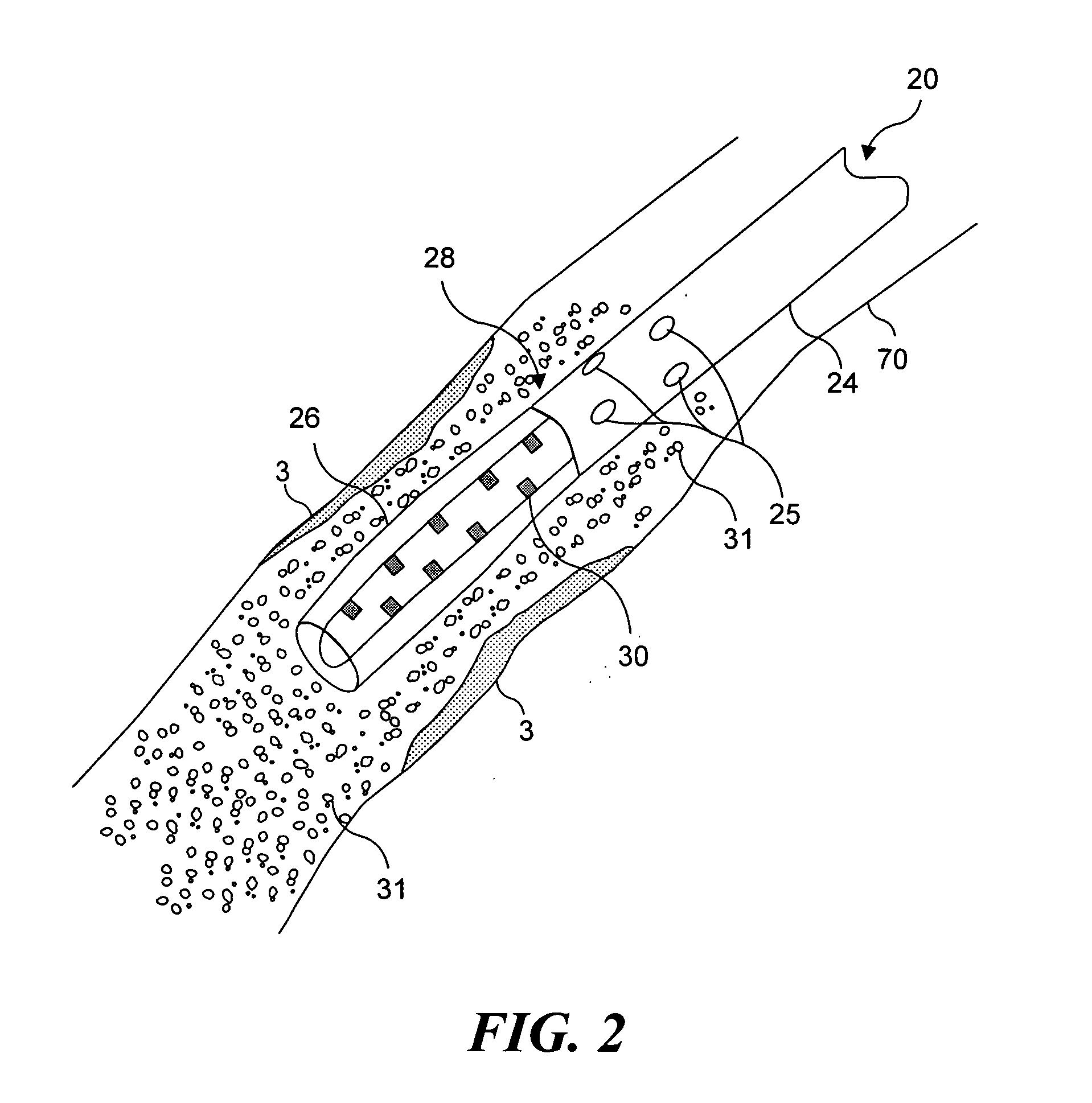 Light generating device that self centers within a lumen to render photodynamic therapy