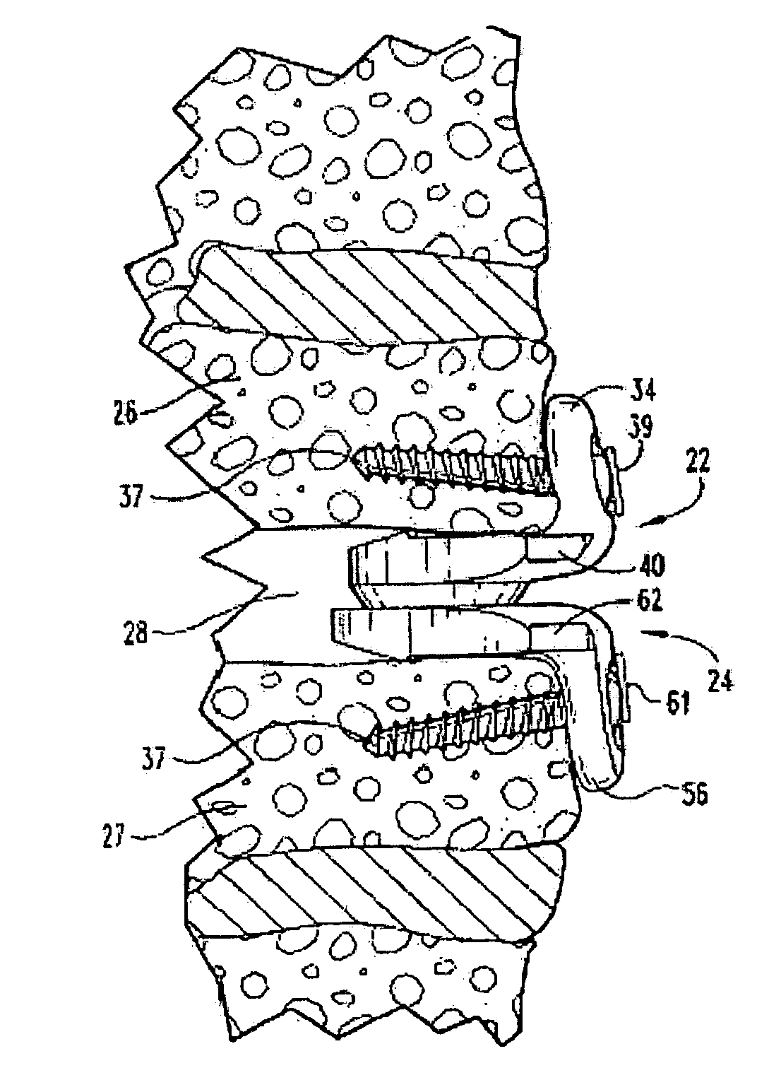 Articulating spinal disc implants with amorphous metal elements