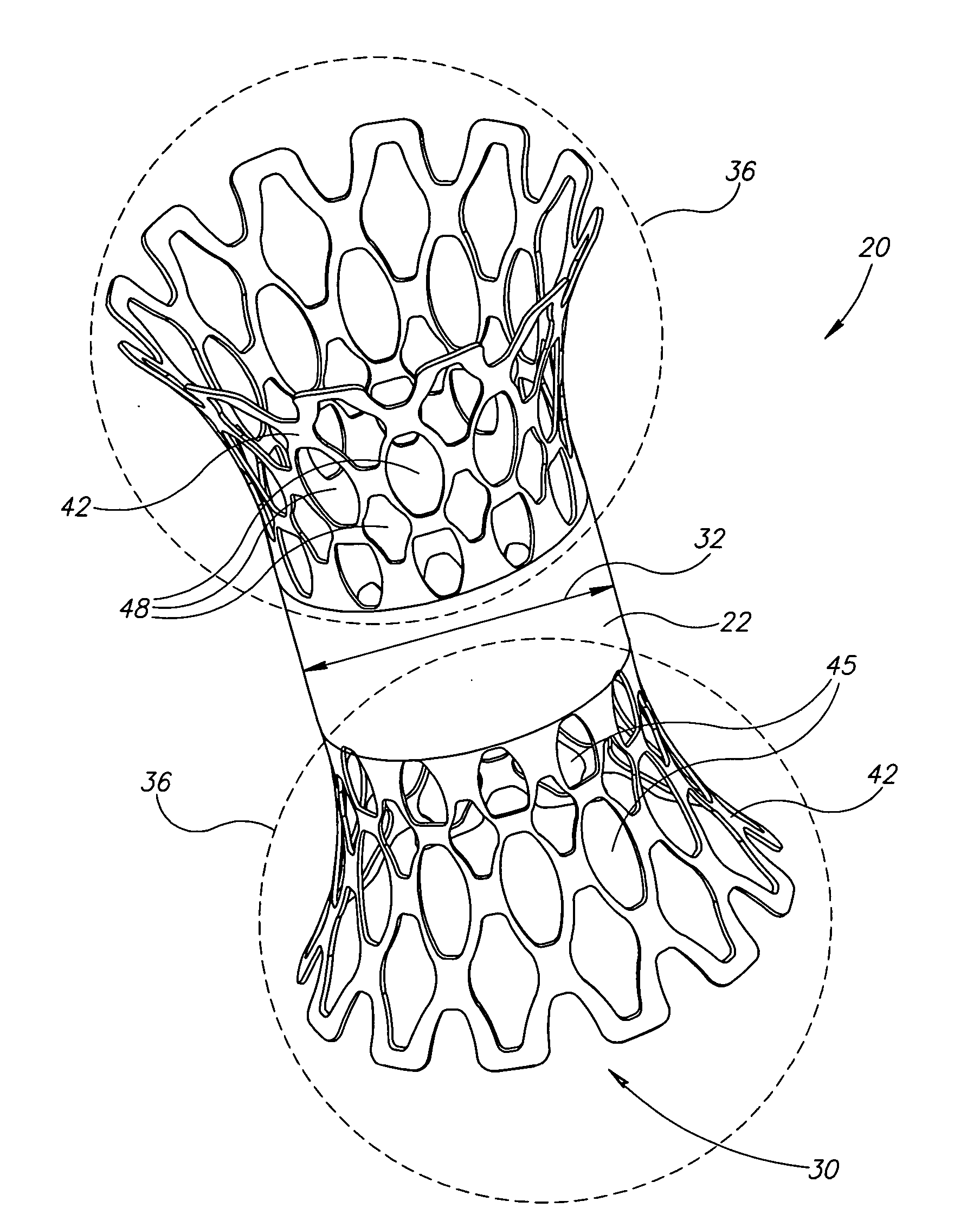 Device and method for treating ischemic heart disease