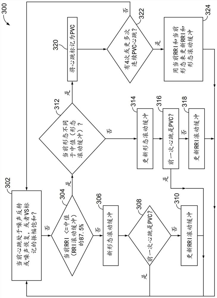 System for identifying preventricular contractions