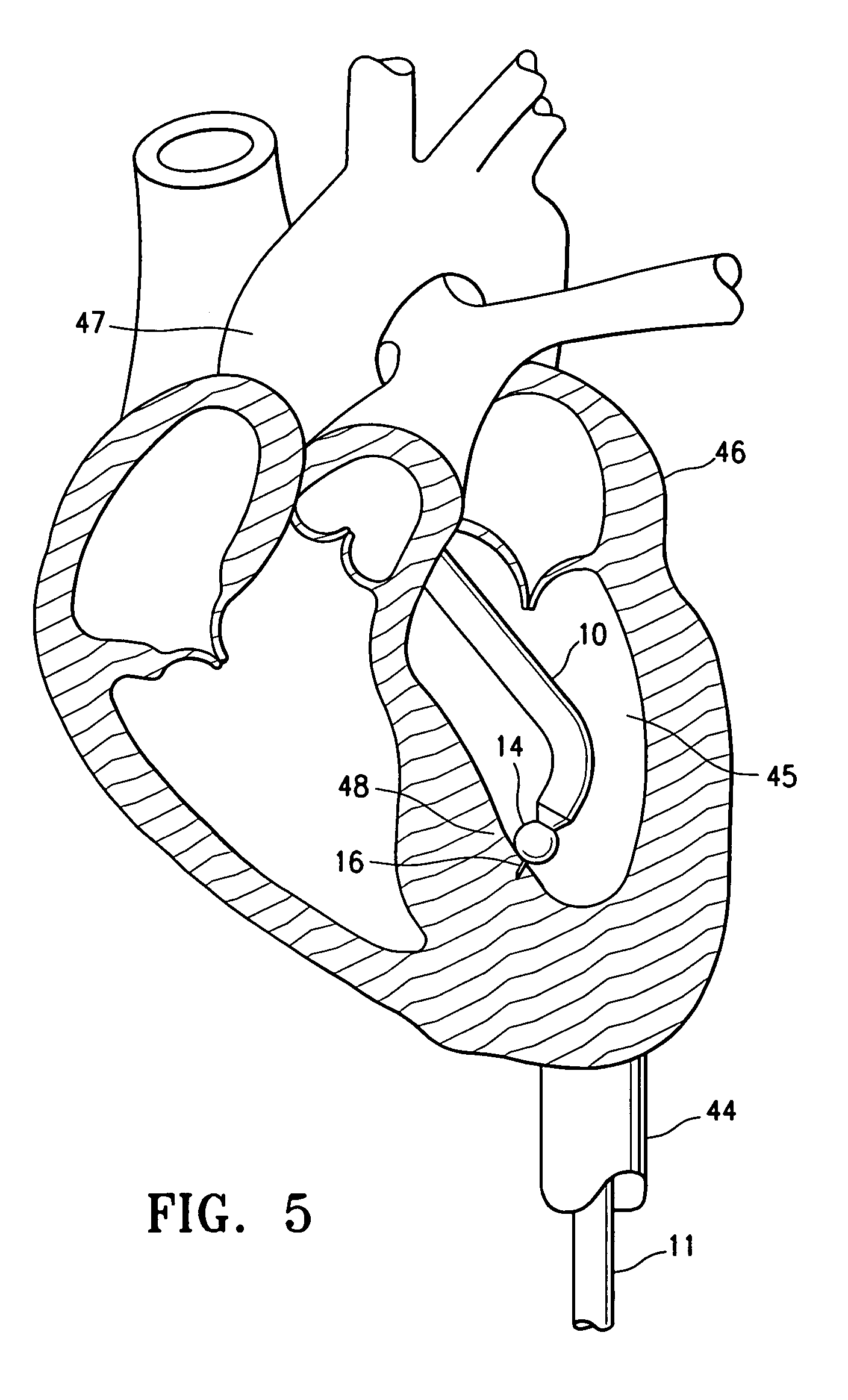 Echogenic needle catheter configured to produce an improved ultrasound image