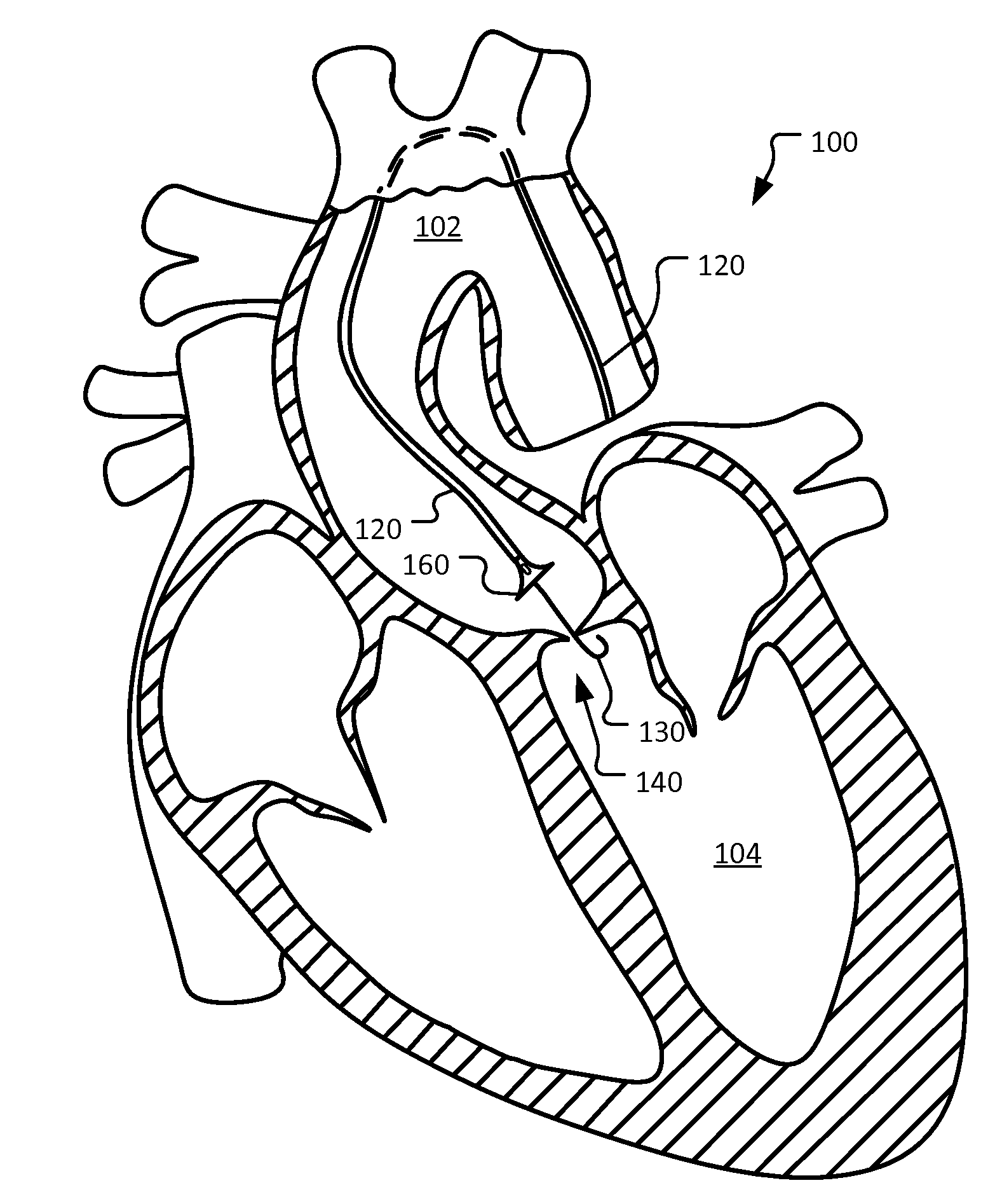 Device and methods for self-centering a guide catheter