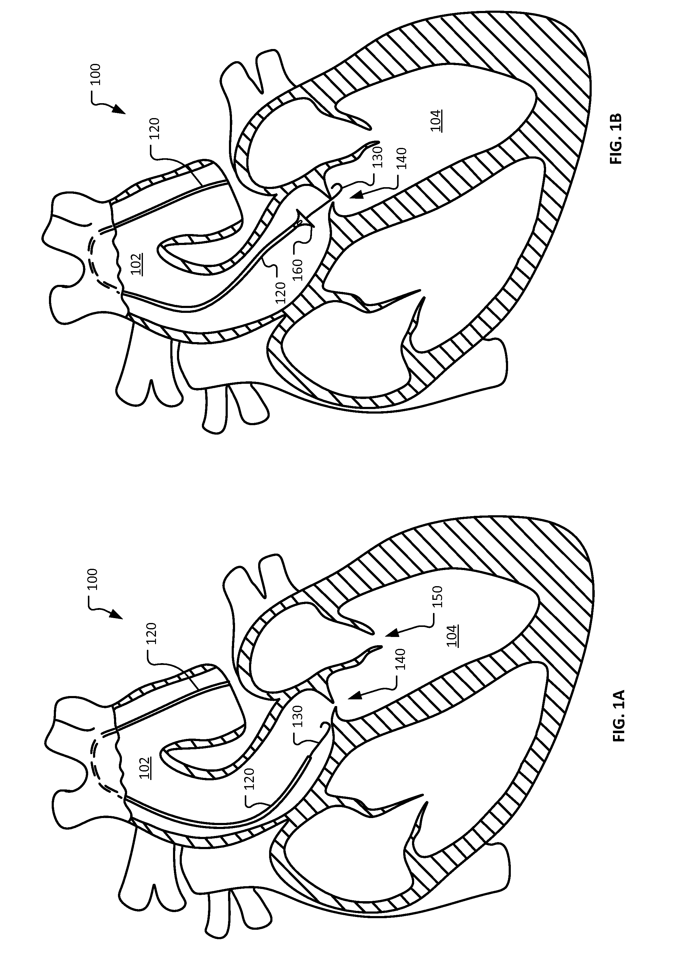 Device and methods for self-centering a guide catheter