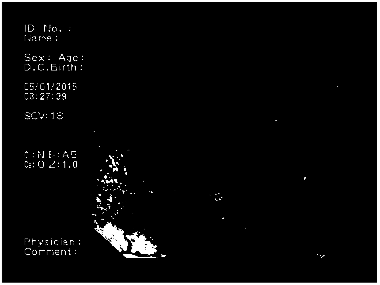 Digestive endoscopy image abnormal feature real-time labeling system and method