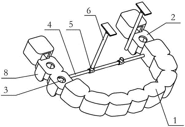 Dental implant guide plate