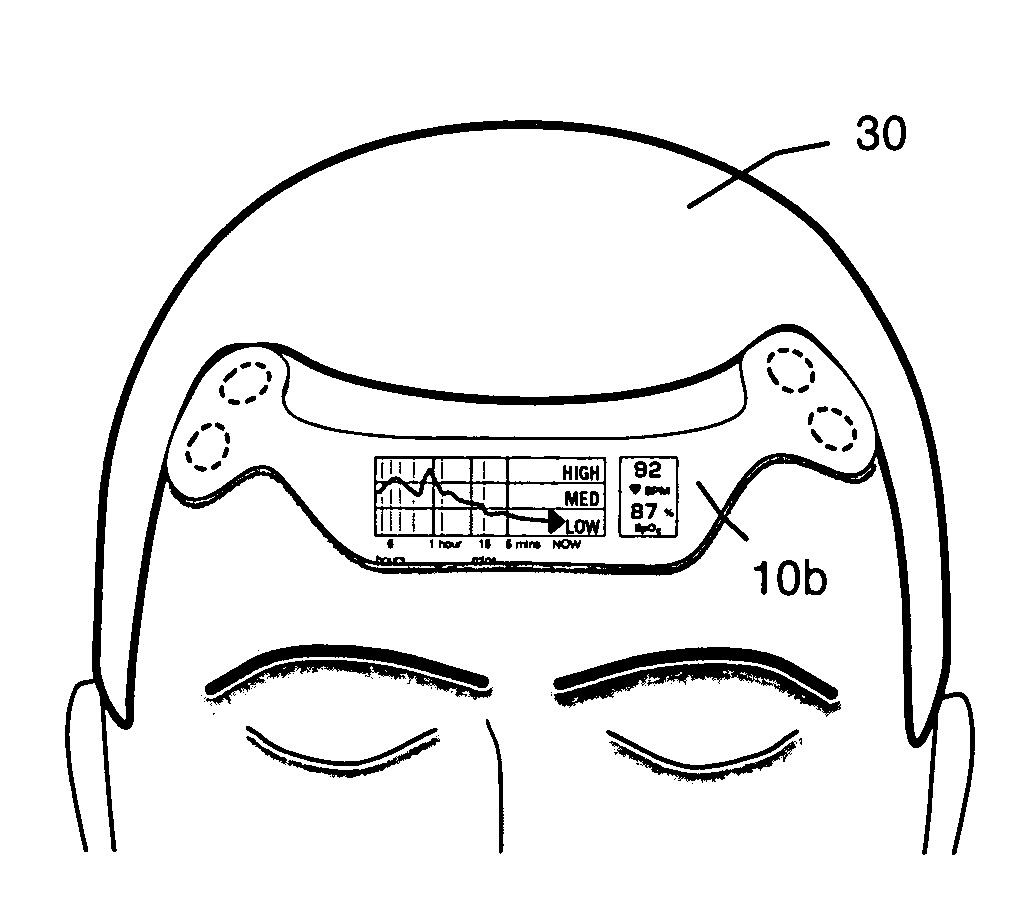 Self-contained surface physiological monitor with adhesive attachment