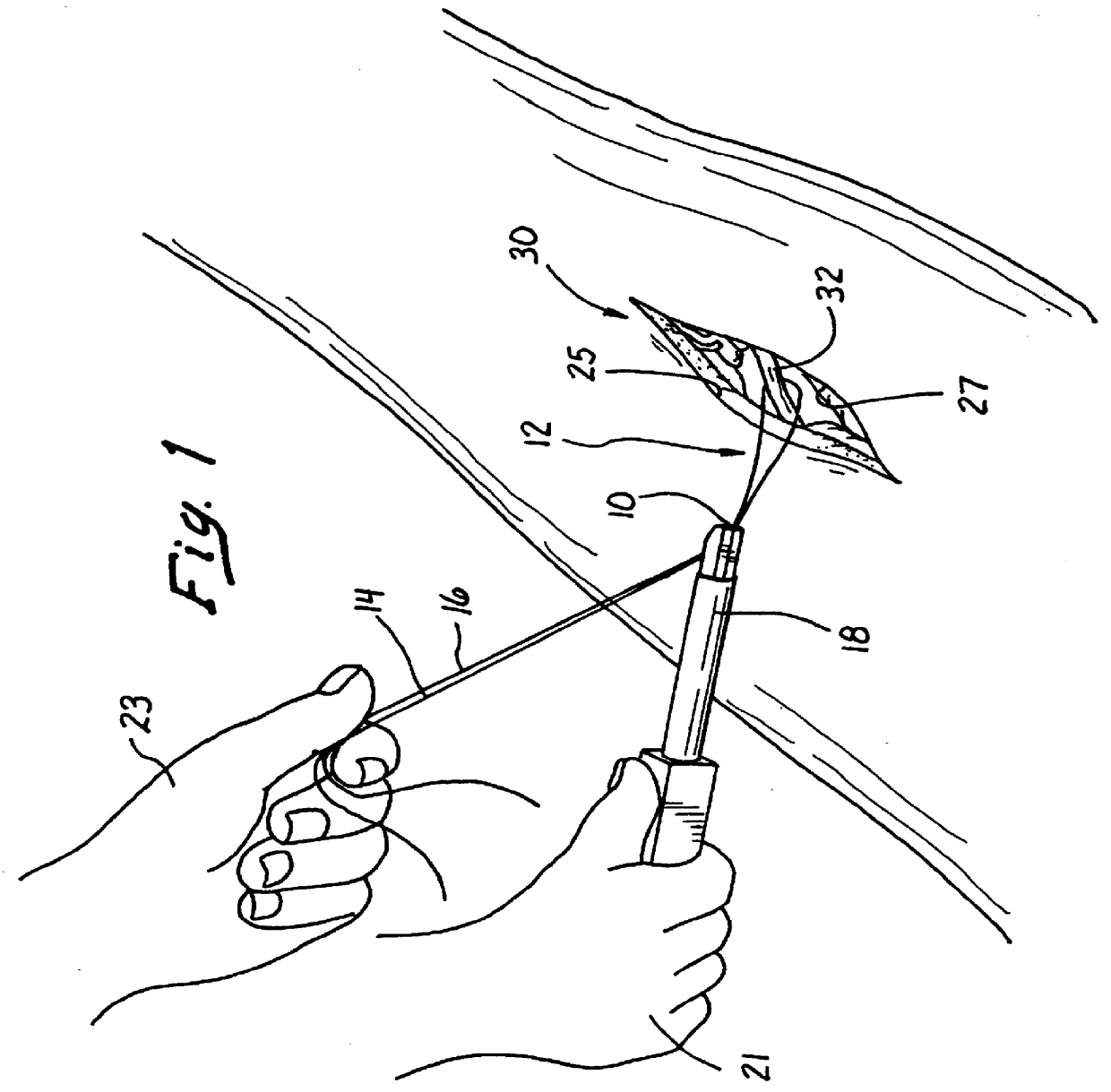 Suture clinch