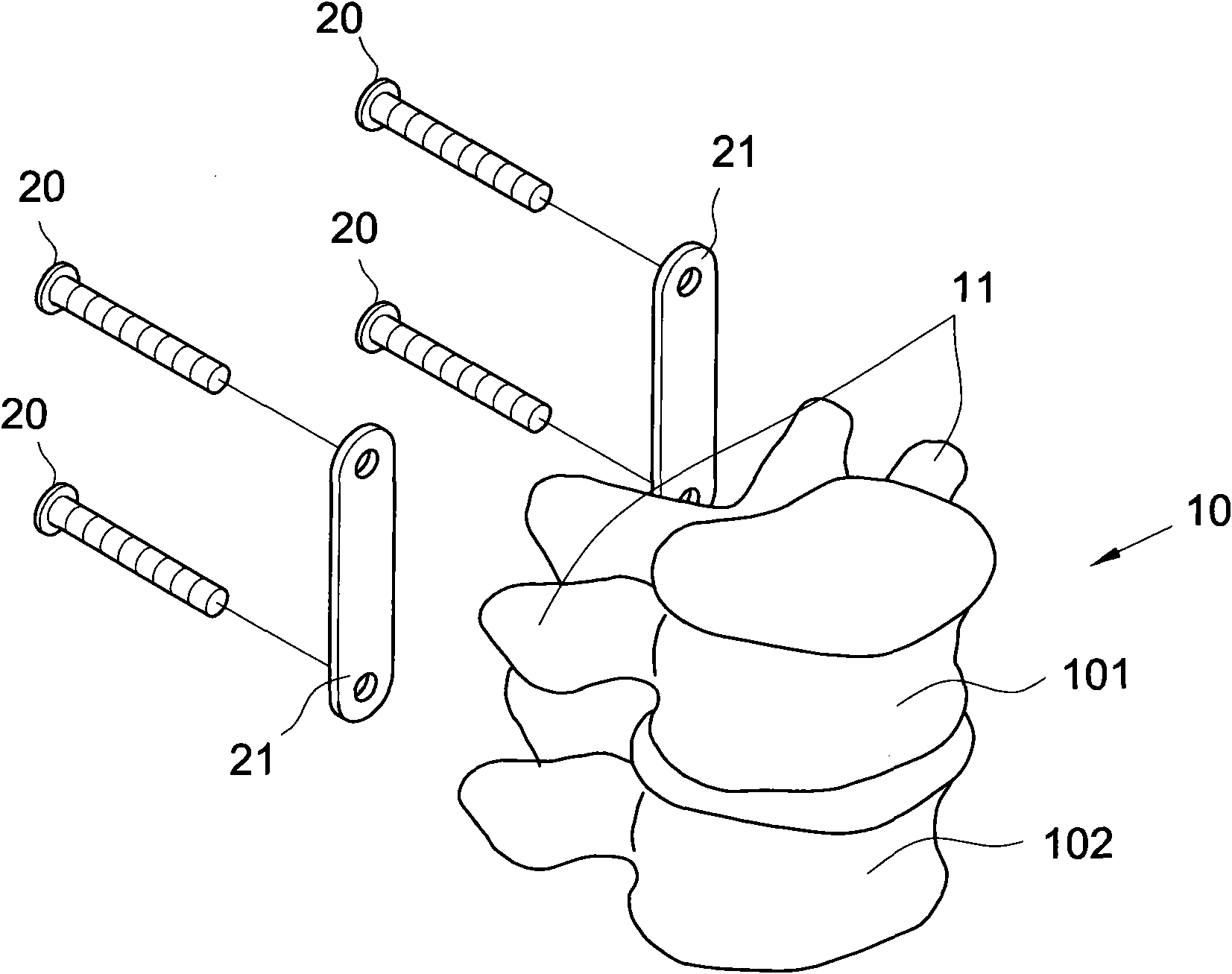 Fixing device for neutralizing actions between two vertebral bodies