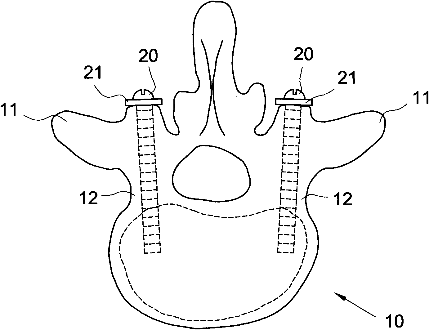 Fixing device for neutralizing actions between two vertebral bodies