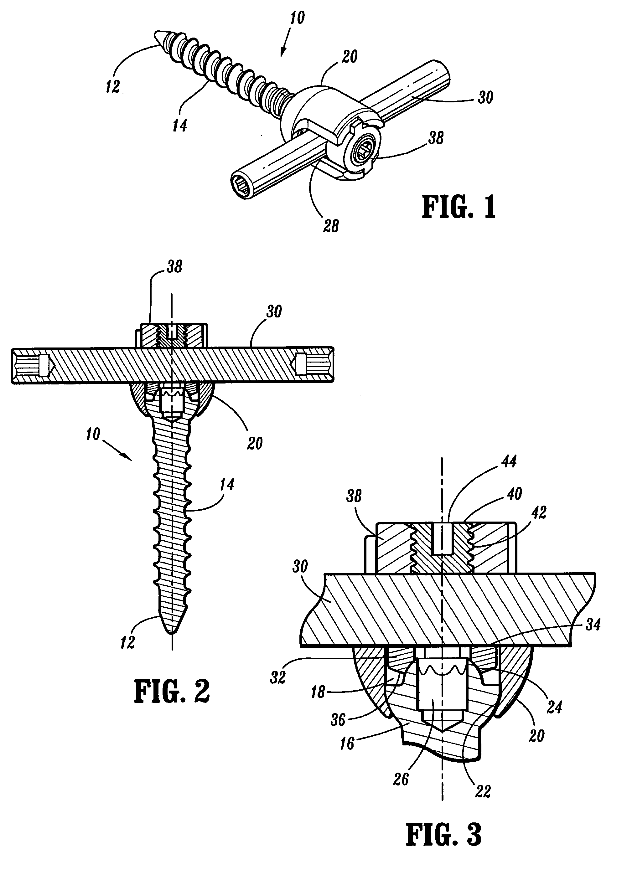 Orthopedic rod system