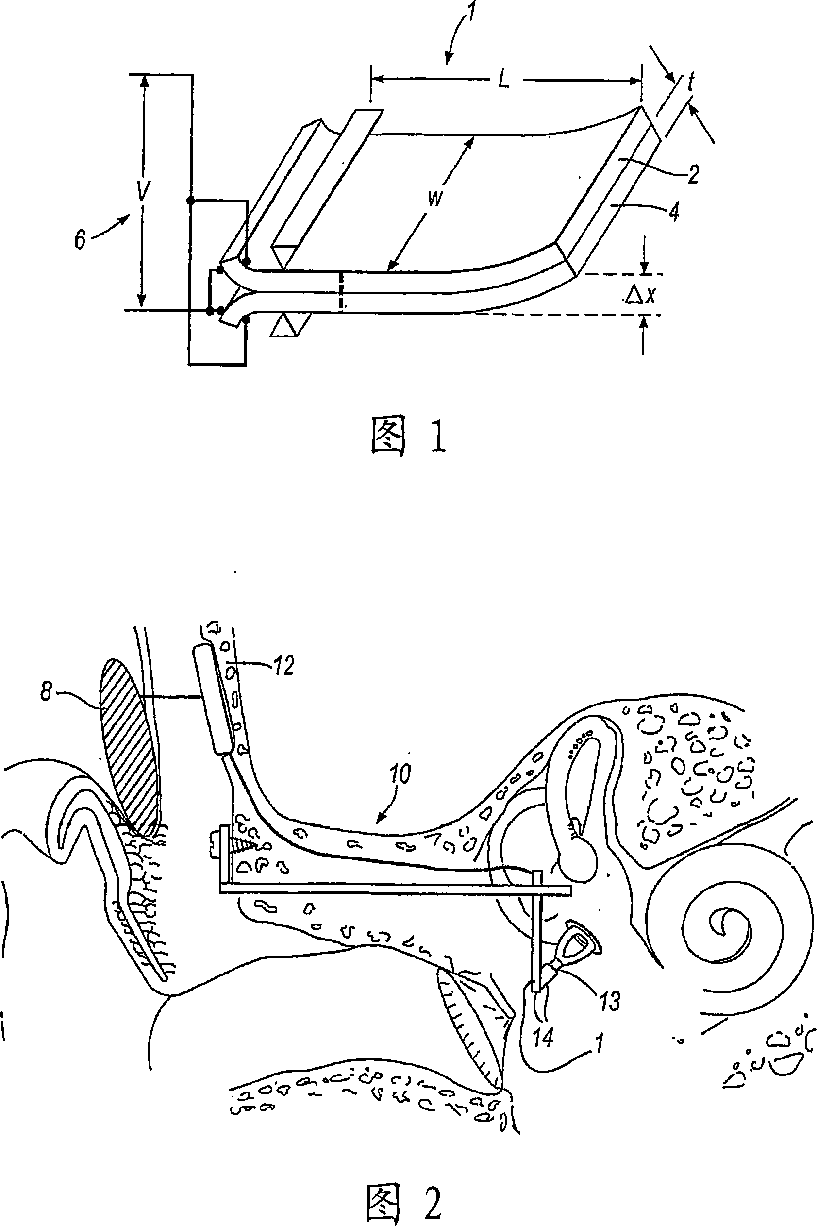 Hearing implant