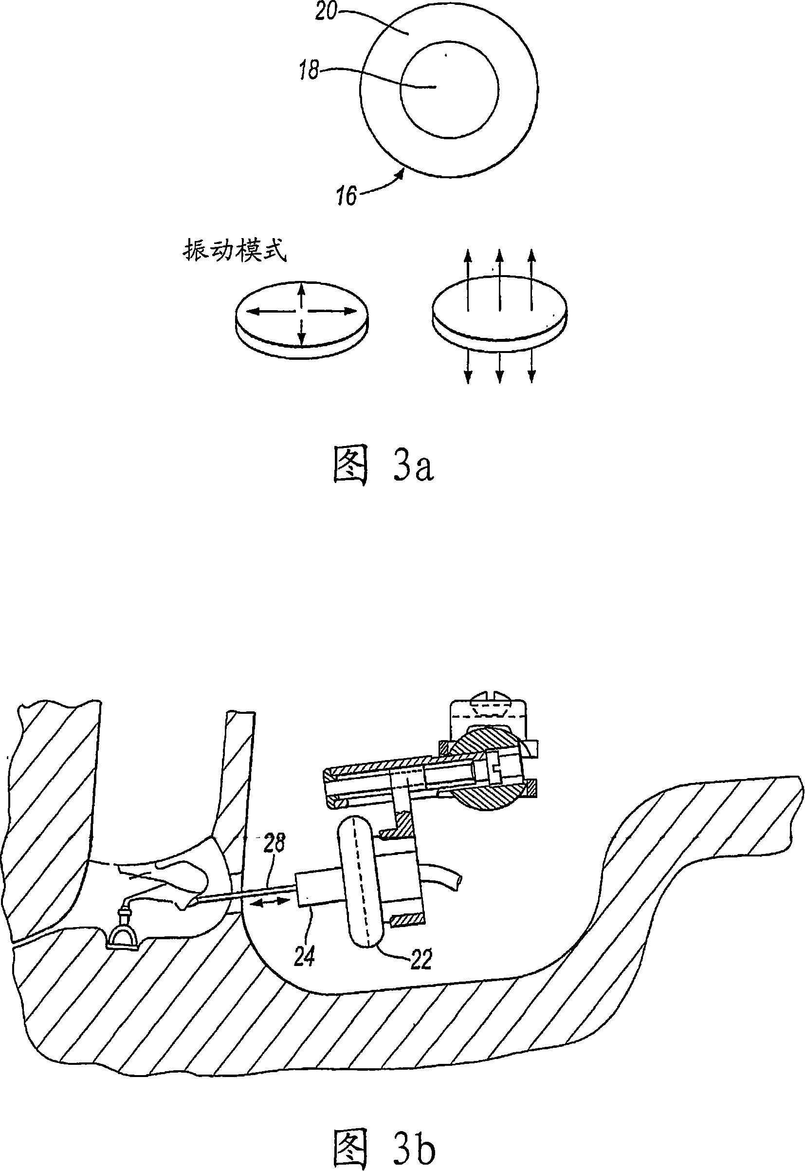 Hearing implant