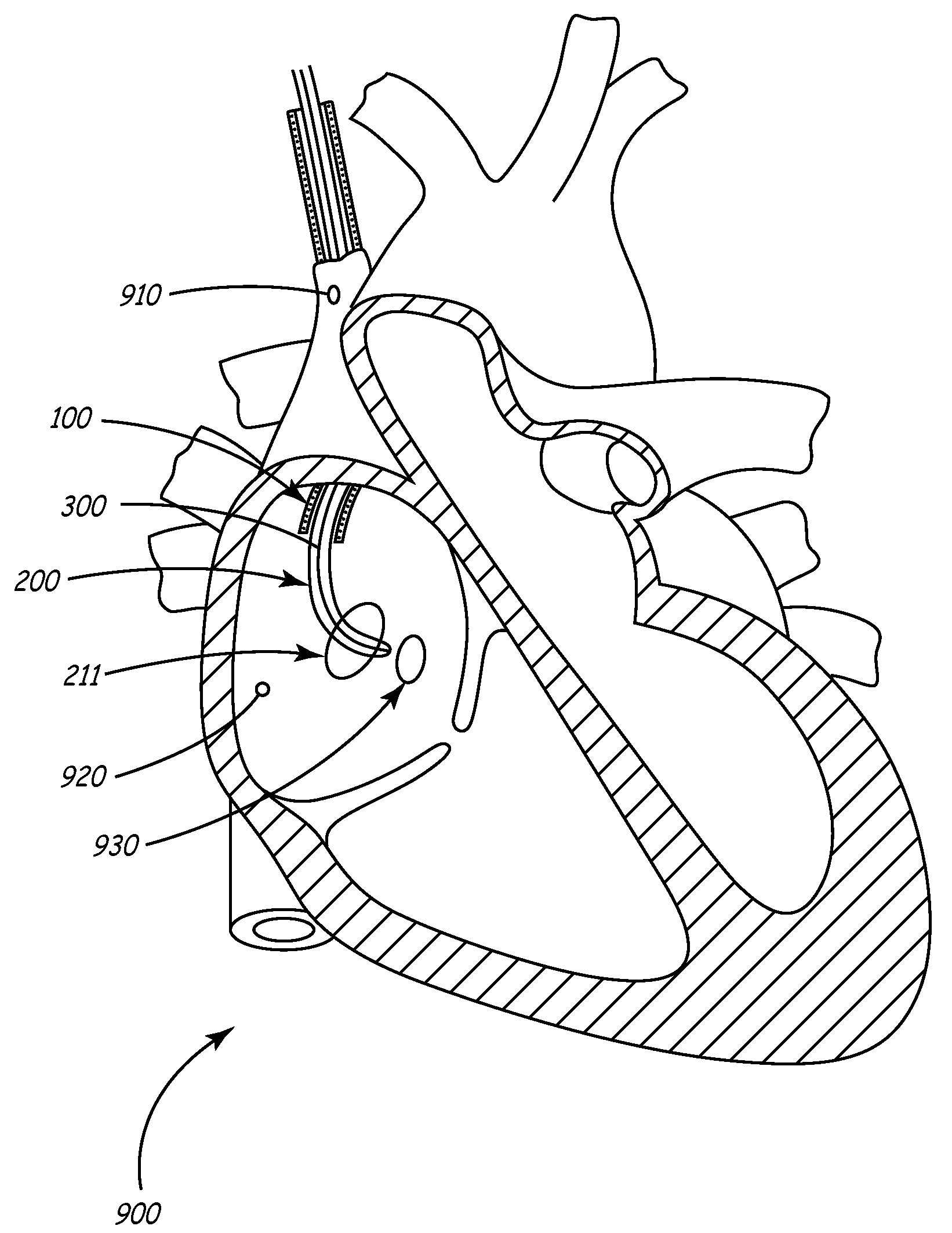 System and method for positioning implantable medical devices within coronary veins