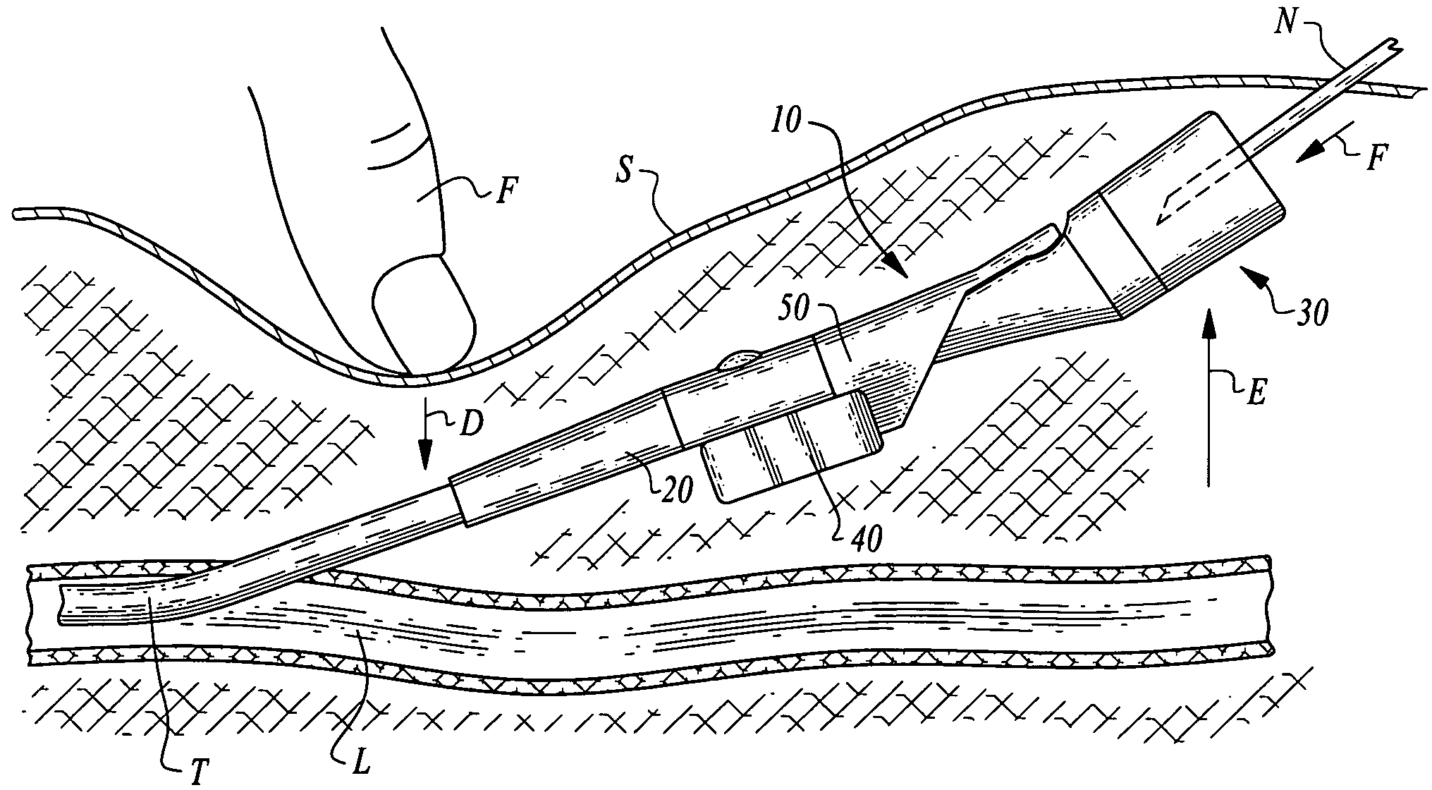 Stabilized elongate implantable vascular access device