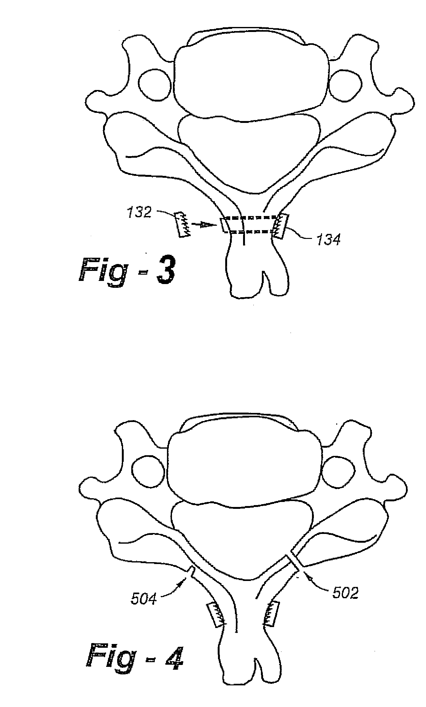 Laminoplasty apparatus and methods