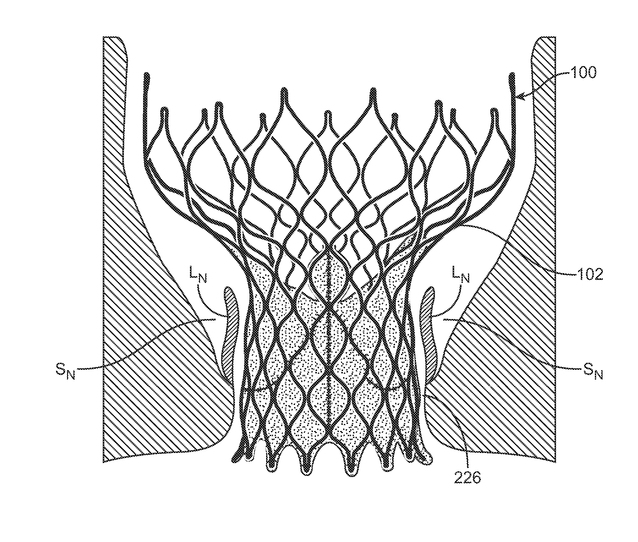 Anti-Paravalvular Leakage Component for a Transcatheter Valve Prosthesis