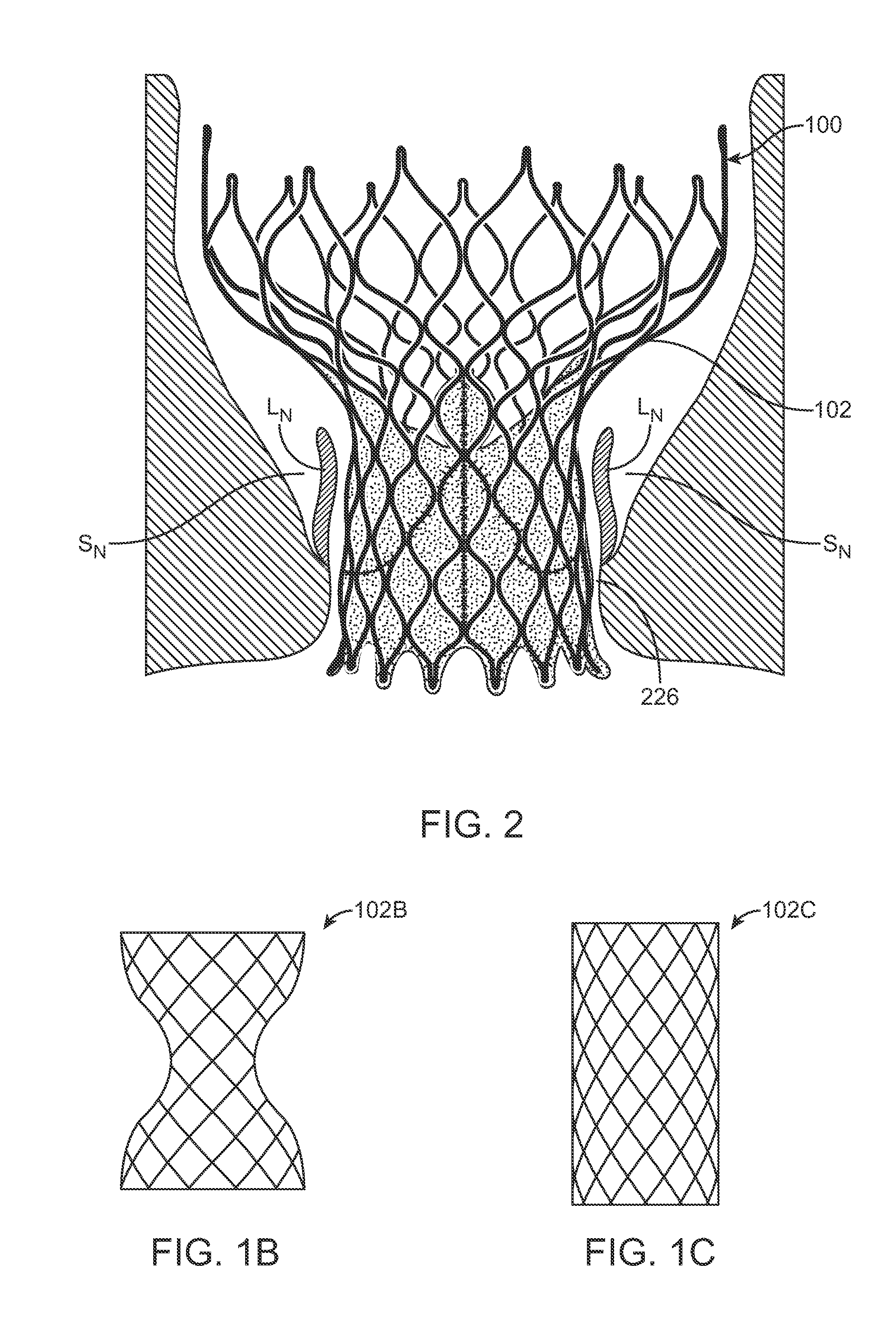 Anti-Paravalvular Leakage Component for a Transcatheter Valve Prosthesis