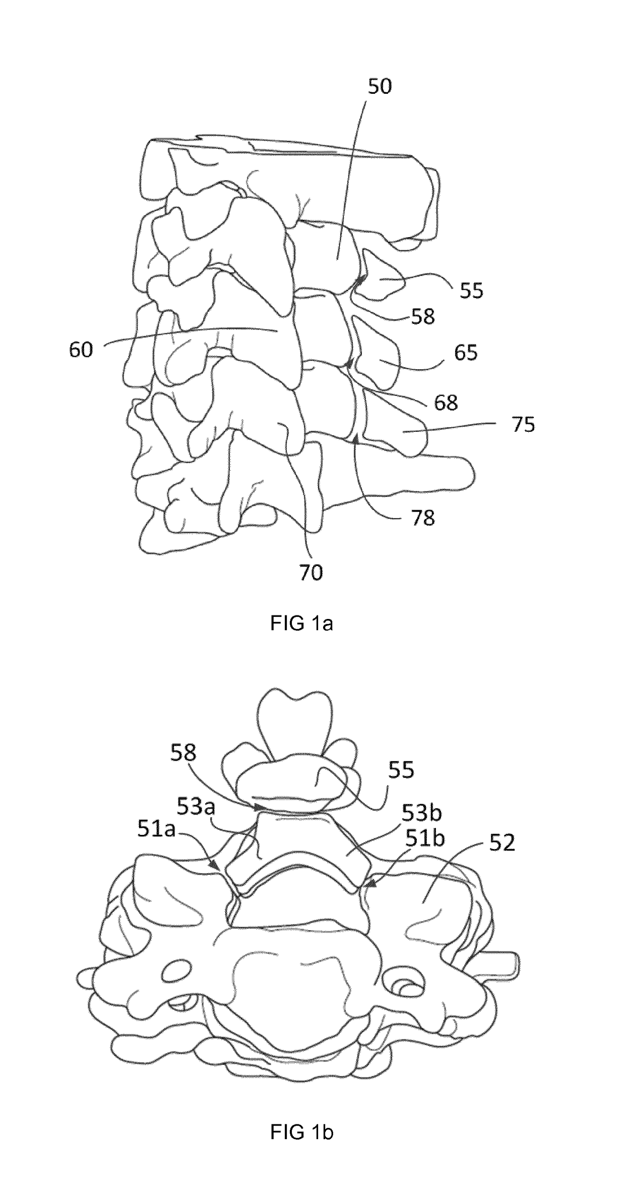 Surgical instruments and methods