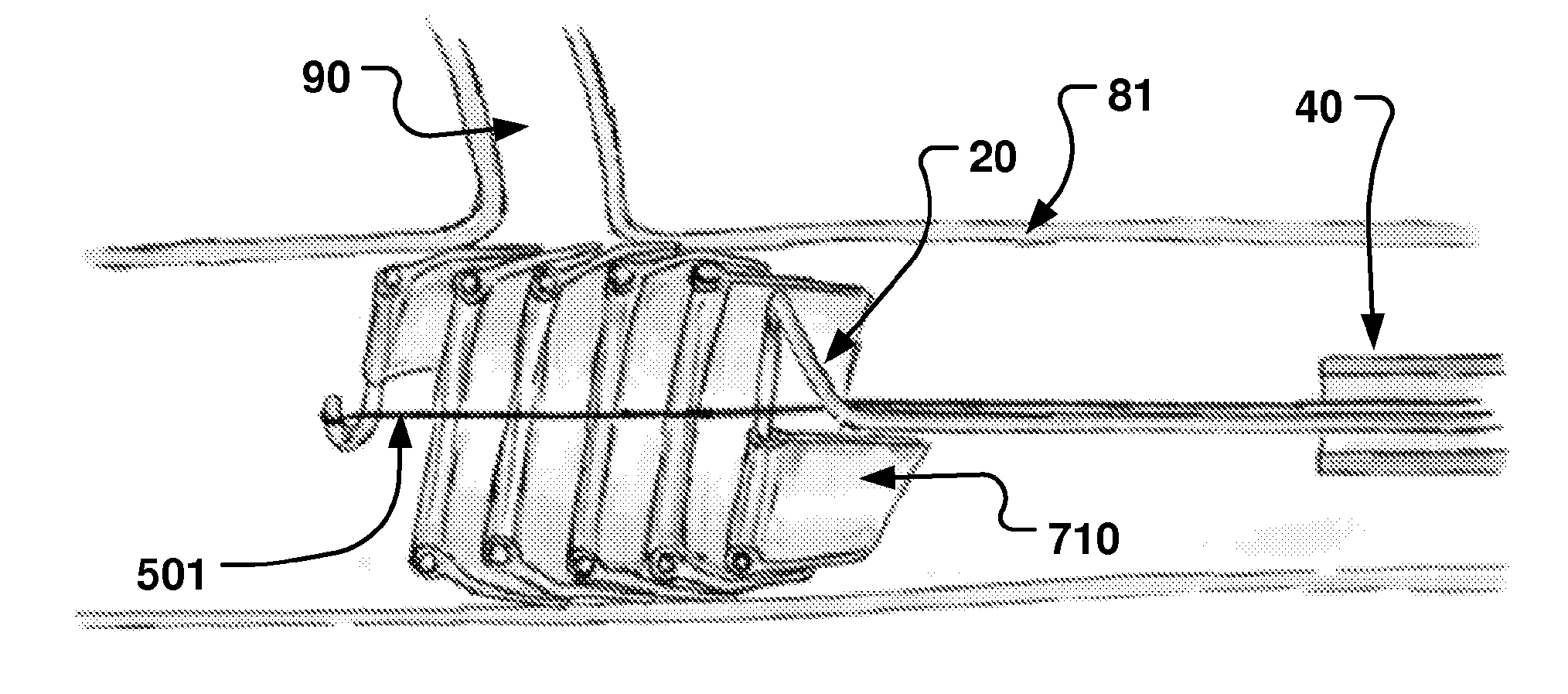 Medical Device, Method And System For Temporary Occlusion Of An Opening In A Lumen Of A Body