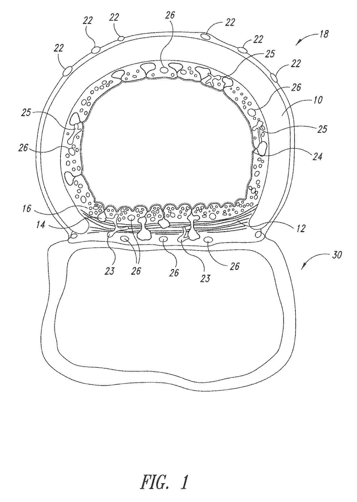 System and method for pulmonary treatment