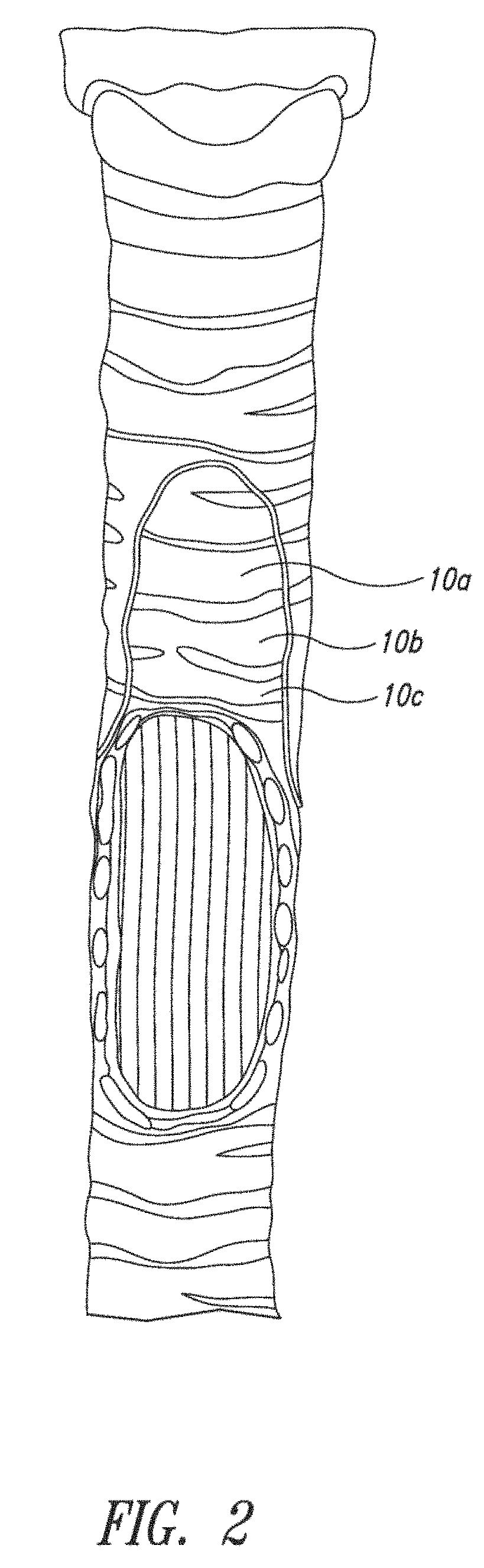 System and method for pulmonary treatment