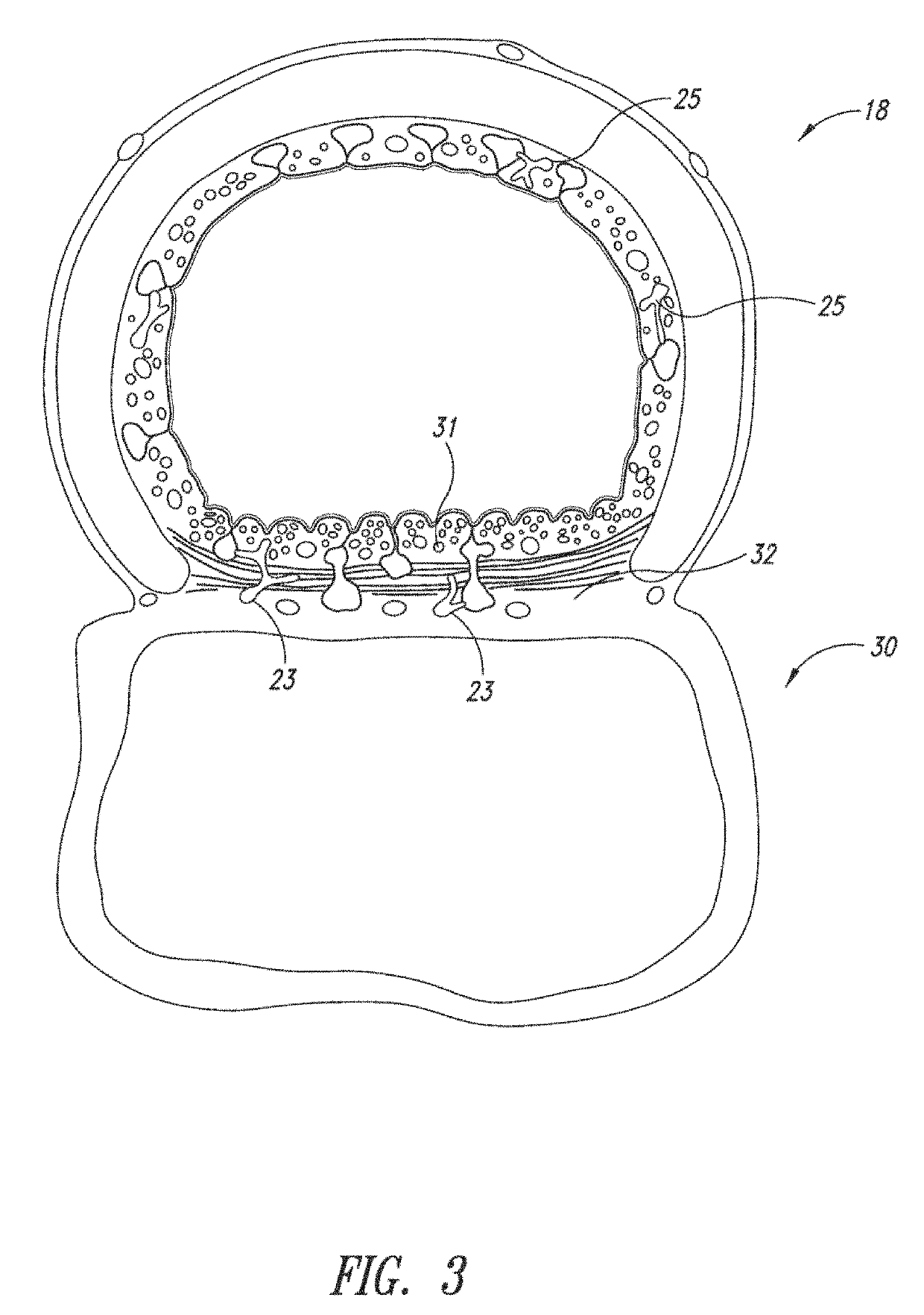 System and method for pulmonary treatment