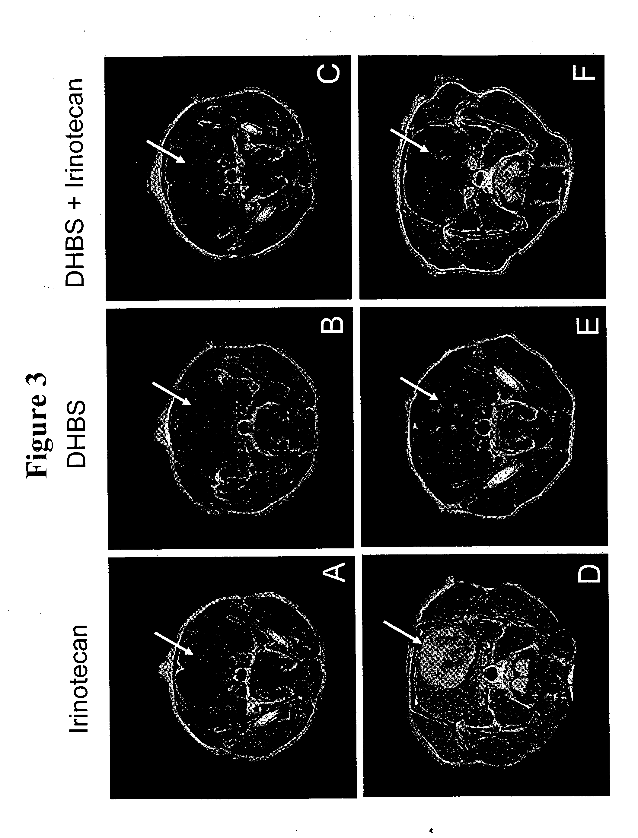 Methods of use for 2,5-dihydroxybenzene sulfonic acid compounds for the treatment of cancer, rosacea and psoriasis