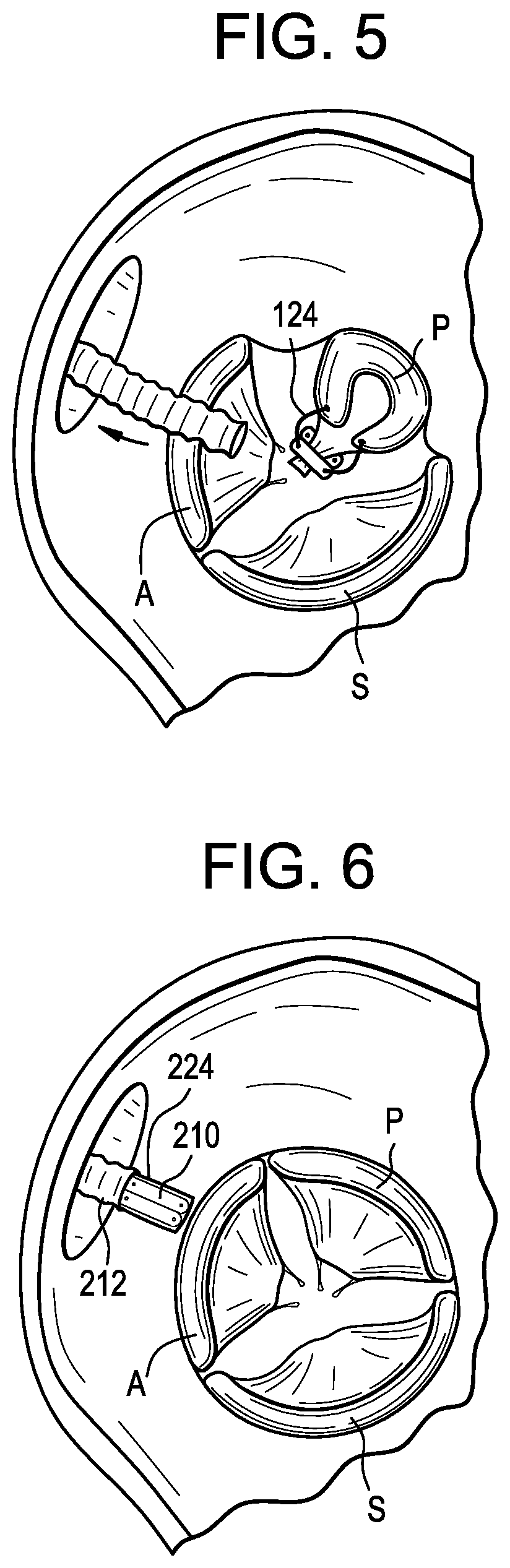 Device and method to plicate the tricuspid valve