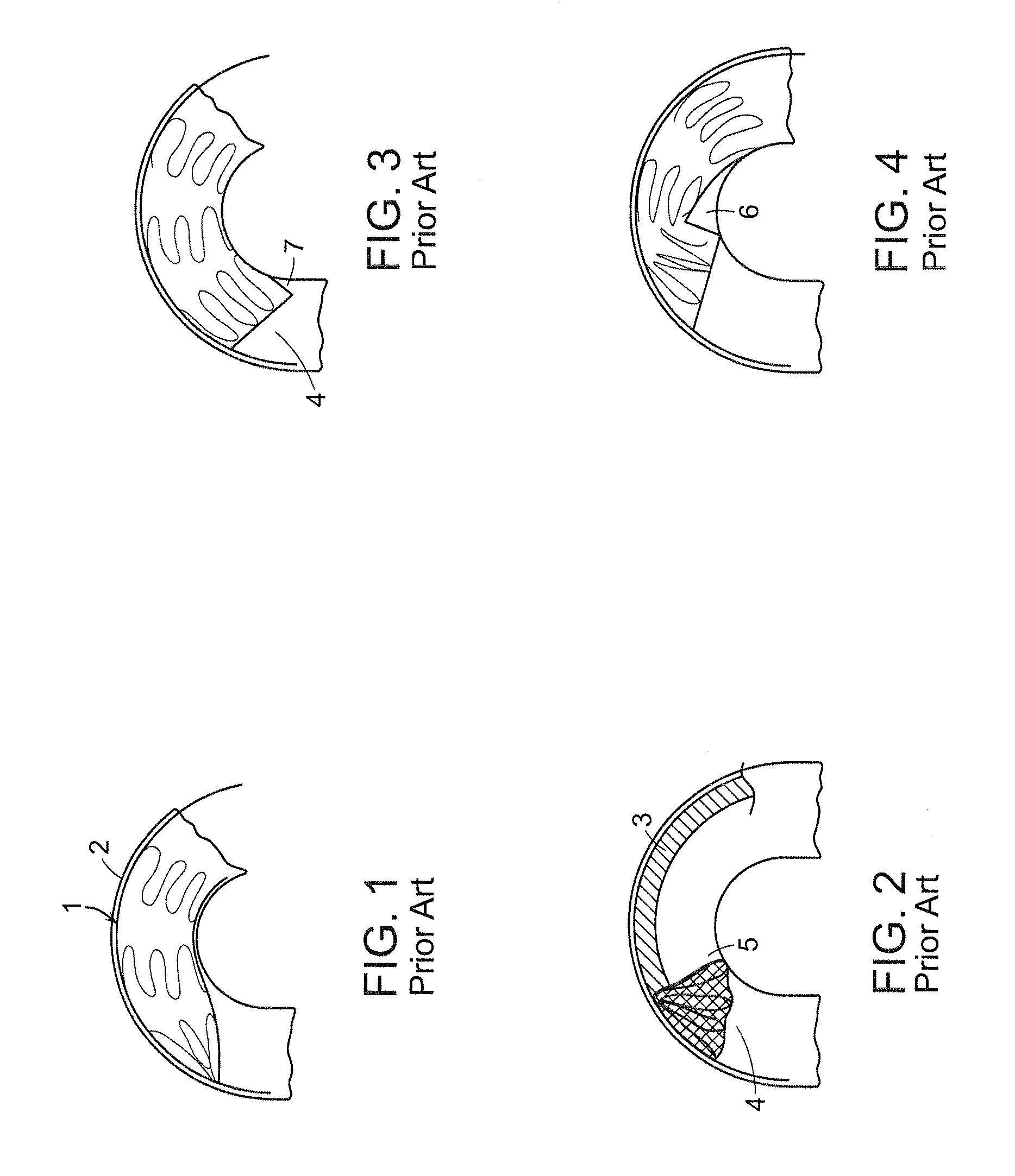 System and method for deploying an endoluminal prosthesis at a surgical site