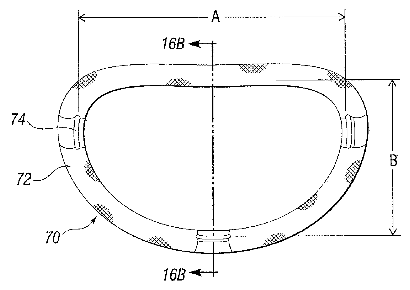 Degenerative Valvular Disease Specific Annuloplasty Rings